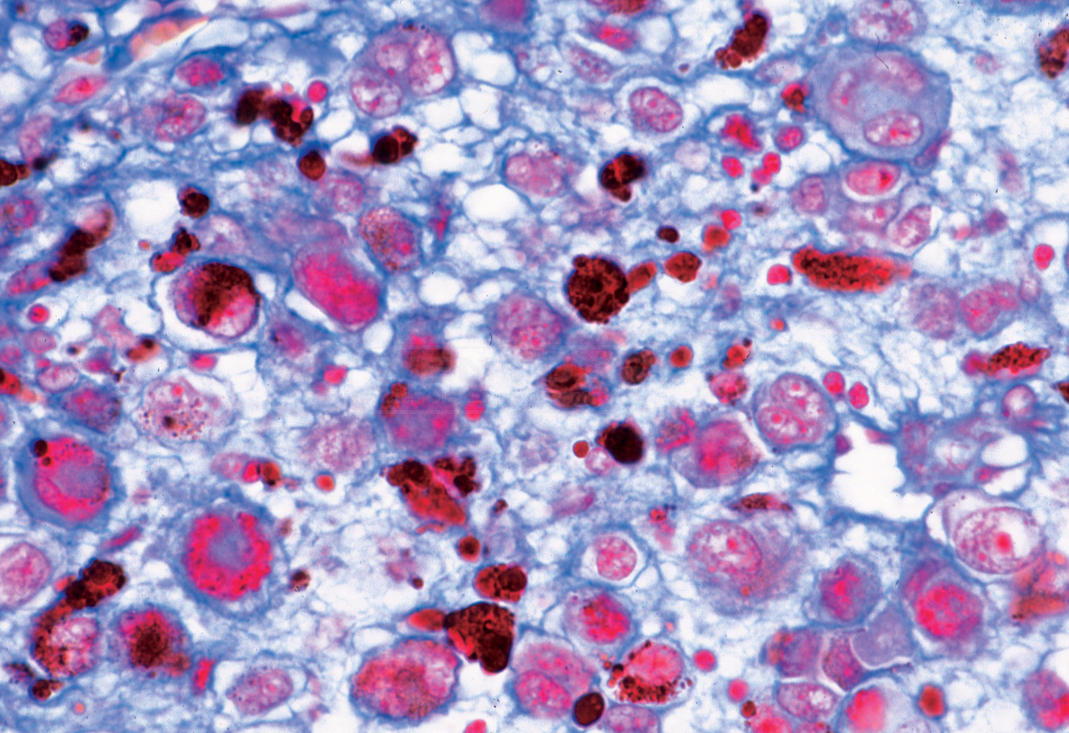 Preparaciones: Patología humana (50x)